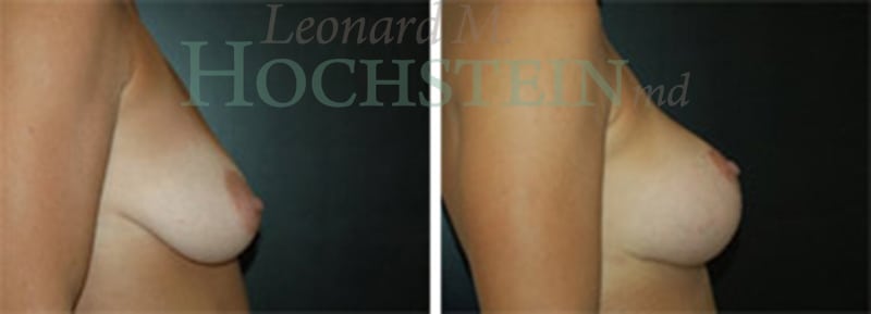 Breast Lift With Implants Patient