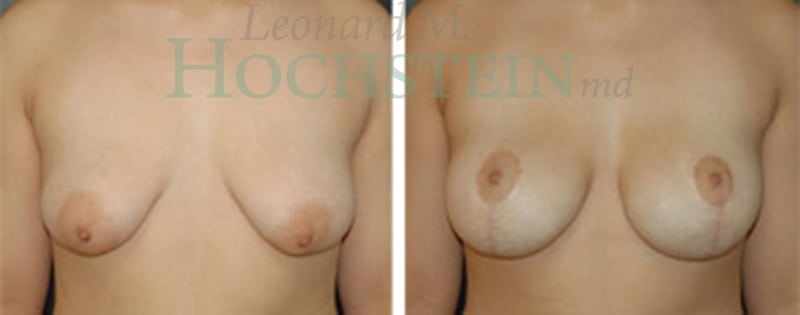 Breast Lift With Implants Patient