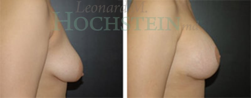 Breast Lift With Implants Patient