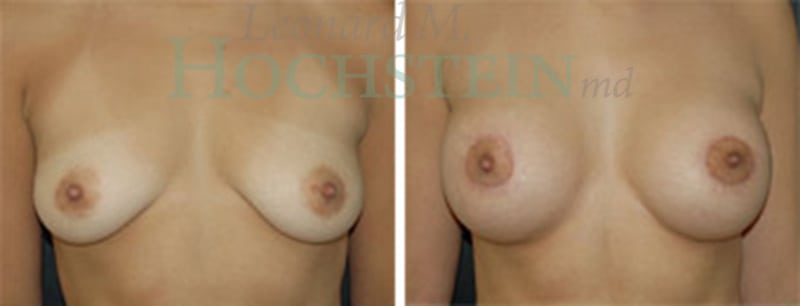 Breast Lift With Implants Patient