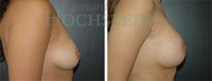 Breast Lift With Implants Patient