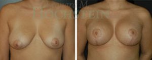 Breast Lift With Implants Patient