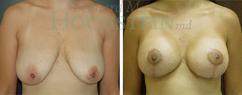 Breast Lift With Implants Patient