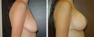 Breast Lift With Implants Patient