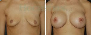 Breast Lift With Implants Patient