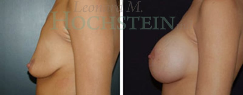 Breast Lift With Implants Patient