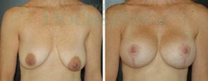 Breast Lift With Implants Patient