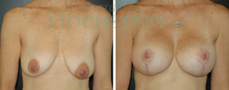 Breast Lift With Implants Patient
