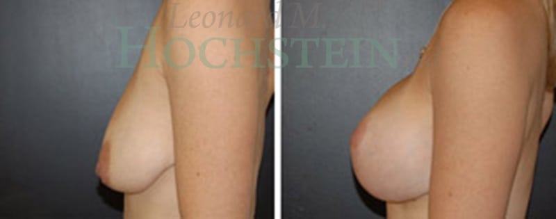 Breast Lift With Implants Patient