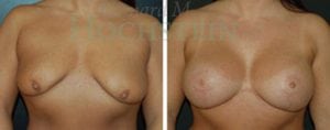 Breast Lift With Implants Patient