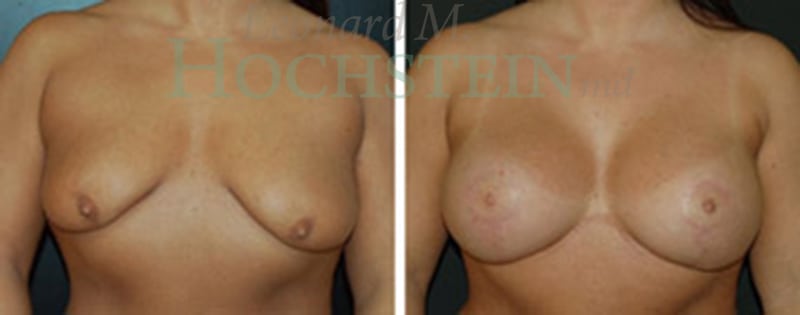 Breast Lift With Implants Patient