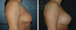 Breast Lift With Implants Patient