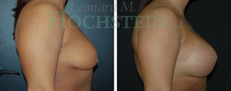 Breast Lift With Implants Patient