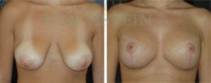 Breast Lift With Implants Patient