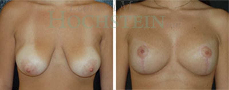 Breast Lift With Implants Patient