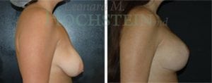 Breast Lift With Implants Patient