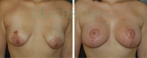 Breast Lift With Implants Patient