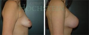 Breast Lift With Implants Patient