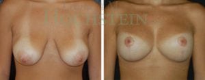 Breast Lift With Implants Patient