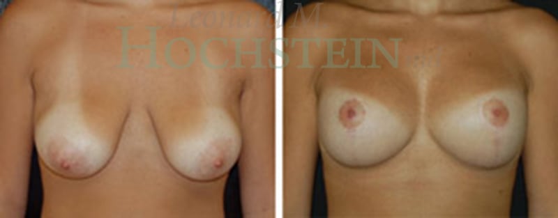 Breast Lift With Implants Patient