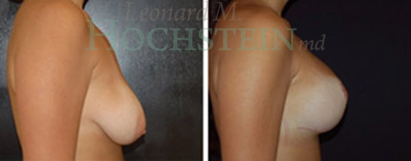 Breast Lift With Implants Patient