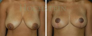 Breast Lift With Implants Patient
