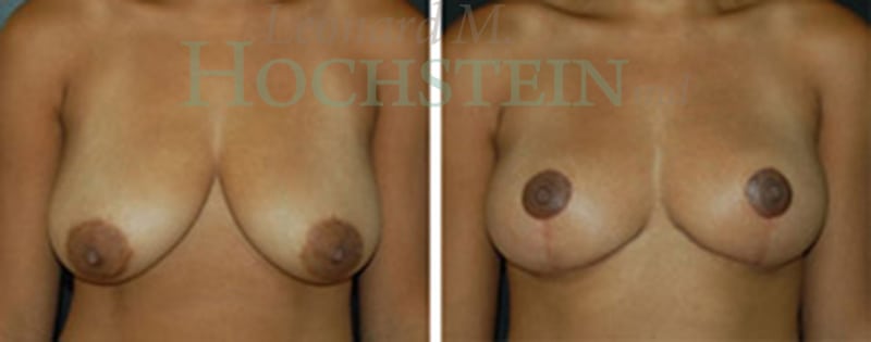 Breast Lift With Implants Patient