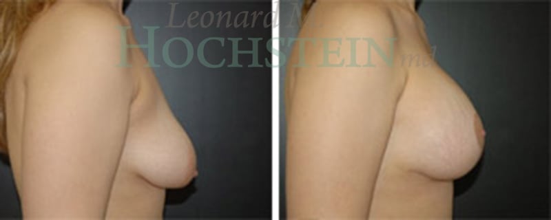 Breast Lift With Implants Patient