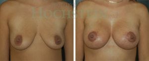 Breast Lift With Implants Patient