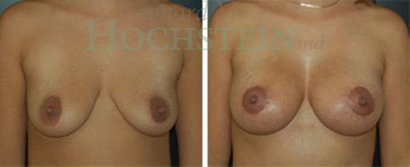 Breast Lift With Implants Patient