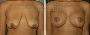 Breast Lift With Implants Patient