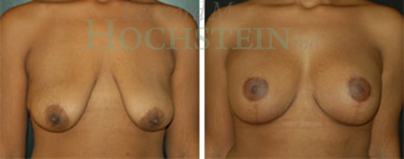 Breast Lift With Implants Patient