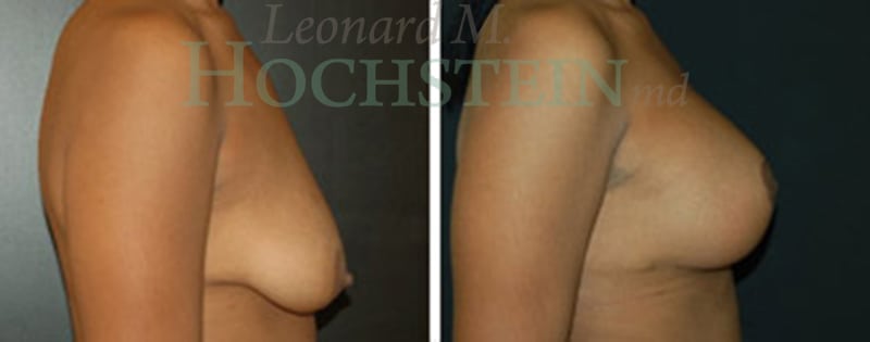 Breast Lift With Implants Patient