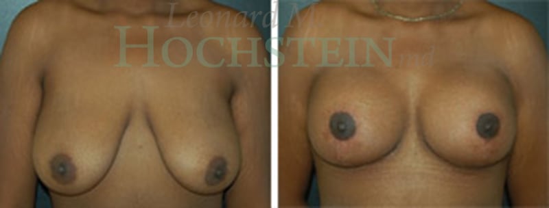 Breast Lift With Implants Patient