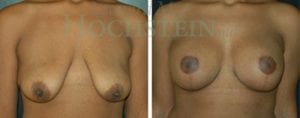 Breast Lift With Implants Patient
