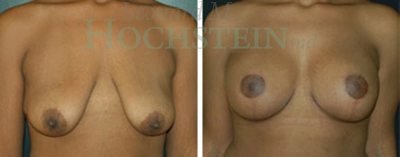 Breast Lift With Implants Patient