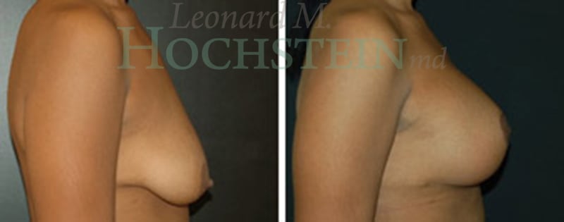 Breast Lift With Implants Patient