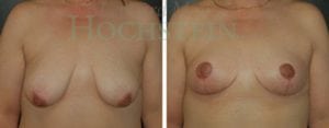 Breast Lift With Implants Patient