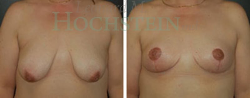 Breast Lift With Implants Patient