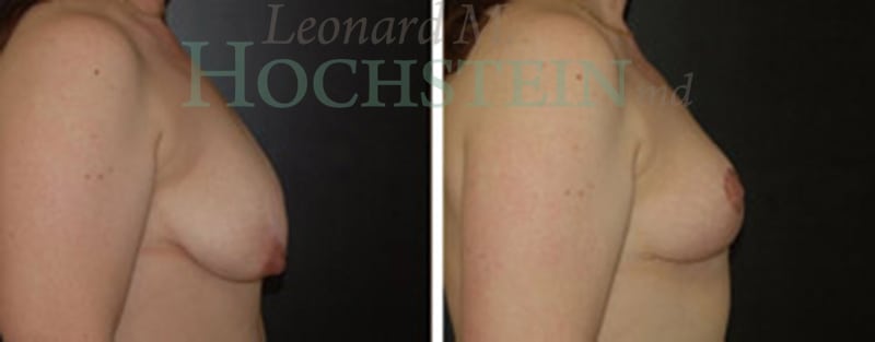 Breast Lift With Implants Patient