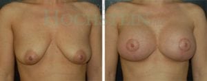 Breast Lift With Implants Patient
