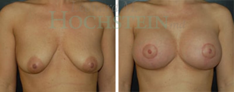 Breast Lift With Implants Patient
