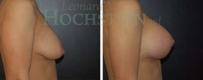 Breast Lift With Implants Patient