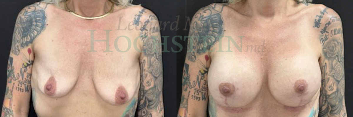 Breast Lift With Implants Patient