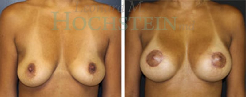 Breast Lift With Implants Patient