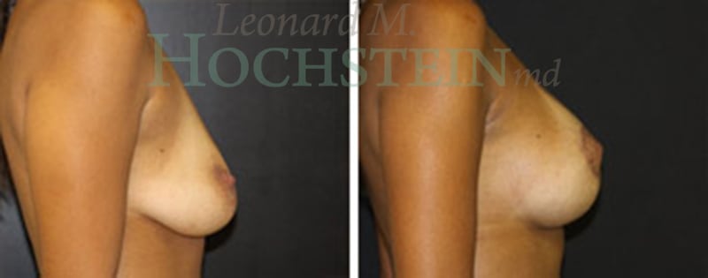 Breast Lift With Implants Patient