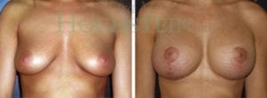 Breast Lift With Implants Patient