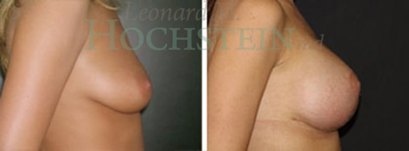 Breast Lift With Implants Patient