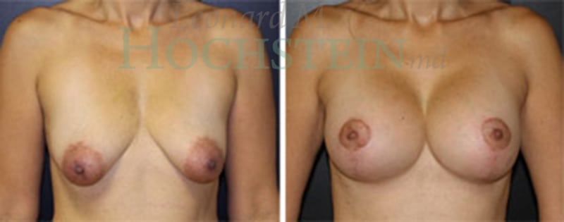 Breast Lift With Implants Patient
