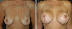 Breast Lift With Implants Patient